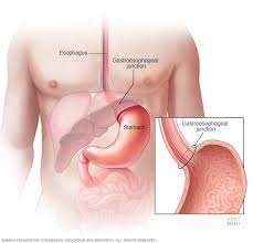Doctors know that male breast cancer occurs when some breast cells divide more rapidly than healthy cells do. Stomach Cancer Symptoms And Causes Mayo Clinic