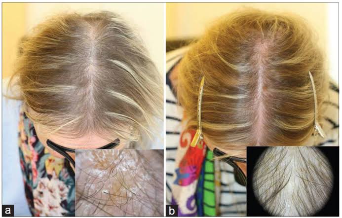 Which Vitamin Deficiencies Can Contribute to Hair Loss?