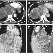 Unenhanced Ct Scan A Demonstrates A Well Defined Heterogeneous Deep Download Scientific Diagram