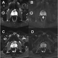 Check spelling or type a new query. Pdf Optimization Of Prostate Mri Acquisition And Post Processing Protocol A Pictorial Review With Access To Acquisition Protocols