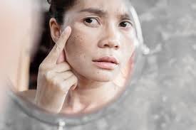 Selain bermanfaat untuk mempercantik kulit wajah, manfaat sabun pepaya juga bisa mengurangi rasa gatal di kulit. Freckles Obat Penyebab Gejala Dll Hello Sehat