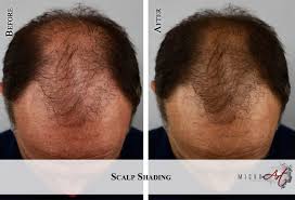 Check spelling or type a new query. Thinning Hair Solution Microart Semi Permanent Makeup Scalp Shading