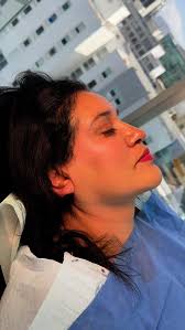 Increible resultado SELFIE PACKAGE con neck lift cerrado con suturas de PDO