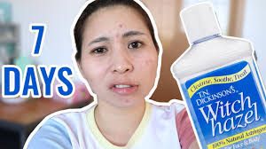 Check spelling or type a new query. Good For Acne Tn Dickinson S Witch Hazel Review Youtube