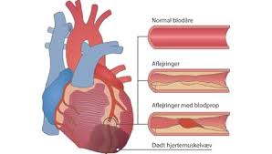 Du kender dem sikkert… symptomerne: Akut Myokardieinfarkt Blodprop I Hjertet Ami Hjerteforeningen