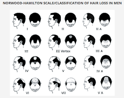This condition can occur at various stages of life where it is most common as a person ages. Stem Cell Hair Treatment Malaysia 2020