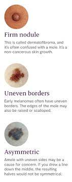There's this one mole on my right hand near my index finger that's pretty light — it's basically a slightly raised flat surface that is the color of milk coffee — and sometimes i just stare at it wondering if it is growing, cancerous, or maybe just a mole i was born with (who knows!!!). What S Your Mole Telling You Maple