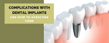 However, most dental implant patients say the procedure doesn't hurt and the discomfort is minimal. Complications With Dental Implants And How To Overcome Them Vccid