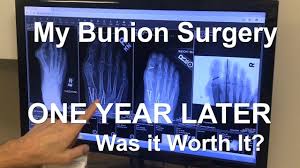 My Bunion Surgery 1 Year Later Was It Worth It Bunion Surgery Bunion Surgery