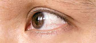 Bindehautentzundung Oder Gerotete Augen Durch Covid 19 Geht Das Unser Auge