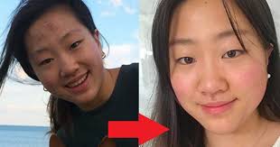 Da vừa mụn vừa thâm nhưng nhờ đến 5 sản phẩm sau, cô nàng đã có được làn da  không tỳ vết đáng ao ước