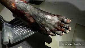 Sebaiknya kita usaha dengan menggunakan rawatan moden dan juga secara herba. Rawatan Al Qalam Youtube