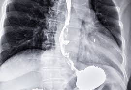 These polyps are rare and usually don't cause any signs or symptoms. Researchers Develop New Breath Test To Diagnose Oesophageal And Gastric Cancer Imperial News Imperial College London