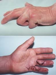 Medizinische Fakultat Universitatsklinikum Magdeburg A O R Gekrummte Finger Was Steckt Dahinter