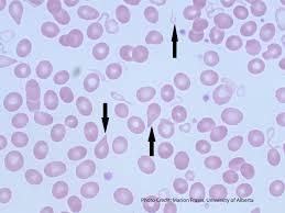 Tear Cells (Dacrocytes, Teardrops) – A Laboratory Guide to Clinical Hematology