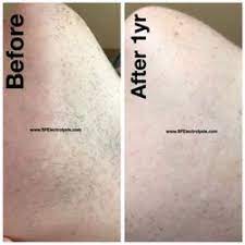 A better solution for hair removal in the san francisco bay area. Best Laser Hair Removal June 2021 Find Lasering Reviews Yelp