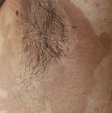 Image result for Erythrasma