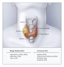 Image result for Nodule