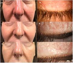 Image result for demodex rosacea