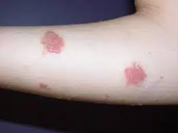Image result for Eczema nummulare