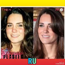 Kate Middleton's Before & After Plastic Surgery. , #katemiddleton  #princewilliam #princeharry #meghanmarkle, #catherine #kate #usa #uk  #canada #australia #royalfamily #katemiddleton #princewilliam ...
