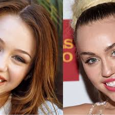 Celebrity Smiles Before and Afters