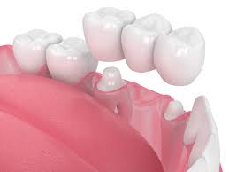 Dental Crowns and Bridges - Restorative Dentistry - Horizon Dental Group
