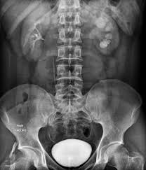 Image result for Nephrolithiasis Imaging