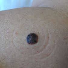 Image result for skin mole