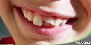 Los Dientes Solo Erupcionan Dos Veces