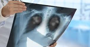 Image result for icd 10 code for pulmonary lesion