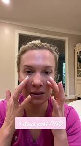 You all. It ain’t pretty. Just an honest look at the current situation.  ##nasalairway #mouthbreathing #brokennose #nosereconstruction