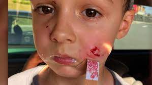 Un Enfant De 5 Ans Aurait Ete Mordu Par Un Chien Tva Cimt Chau
