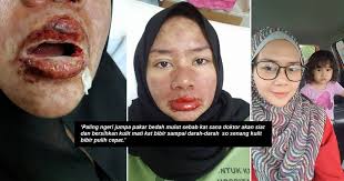 Inilah tips paling sederhana menyembuhkan cara mengobati sakit gigi berlubang besar dapat menggunakan berbagai bahan herbal yang dapat dengan cepat membantu meringankan sakit gigi. Bermula Dari Sakit Gigi Satu Badan Kemerahan Macam Terbakar Mulut Penuh Ulser Bibir Menggelupas Tak Sangka Ini Yang Dialami Akibat Alahan Ubat Vanilla Kismis