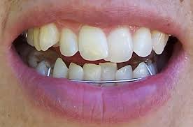 Why do some people wear retainers 24/7, while i only have how long do you have to wear retainers for? How Retainers Work Orthodontics In London