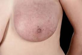 Although it is often a type of invasive ductal carcinoma, it differs from other types of breast cancer in its symptoms, outlook, and treatment. Inflammatory Breast Cancer In Women Symptoms And Treatment