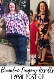 Bariatric Gastric Sleeve Surgery Results This Is An Update 1 Year After Gastric Sleeve Surgery Including Sleeve Surgery Gastric Sleeve Surgery Gastric Sleeve