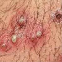 Image result for chancroid