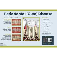 dental wall art periodontal disease chart 24x36 daw014lu