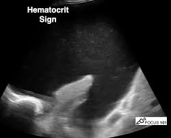 Six patients with either malignant pleural effusion or empyema, in whom multiple conventional attempts at thoracocentesis were unsuccessful, were evaluated by ultrasound. Thread By Pocus101 On Thread Reader App Thread Reader App