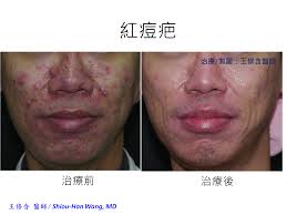 皮膚科王修含醫師: 如何消除紅痘疤？