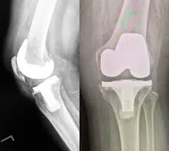 The best swanson broth recipes on yummly | steamed mussels in lemony garlic broth, broth & salsa flavored salmon burgers with turmeric quinoa, mussels and sausage in garlic tomato broth. Implant Identification Orthopaediclist Com