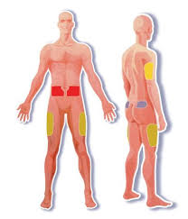 Unusual bleeding or bleeding that lasts a long time. Lovenox Injection Sites Thigh