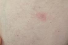 Image result for Inflammatory breast cancer