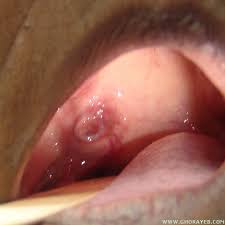 Sinus cancers may also cause symptoms that often accompany less serious conditions, like the common cold, including. Soft Palate Cancer Australia Pdf Ppt Case Reports Symptoms Treatment