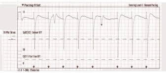 Image result for Transcutaneous Pacing
