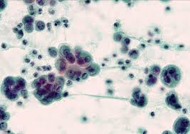 Cytology provides crucial window for early diagnosis of malignant mesothelioma (mm) since it is often the first and easily . Pathology Outlines Diffuse Malignant Mesothelioma