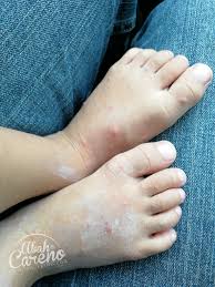 Sabun daun semambu untuk chickenpox atau demam campak. Petua Anak Kena Demam Campak Chicken Pox Blog Abah Careno