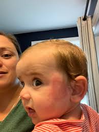 Can babies wear anything over a onesie with a cranial band?