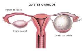 Quistes Ovaricos Que Son Y Como Afectan La Fertilidad Femenina By Ingenes Cumple Tu Sueno Ingenes Medium